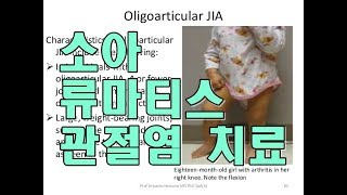 소수 관절형 소아류마티스 관절염 치료사례juvenile idiopathic arthritis [upl. by Ivgnout]