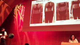 Clinical and radiological improvement of scoliosis with Schroth BSPTS exercises SOSORT Meeting 201 [upl. by Annaili471]