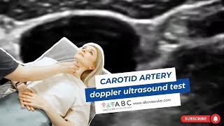 Carotid artery Doppler ultrasound test Accurate examination to perform a basic ultrasound carotid [upl. by Stillas]