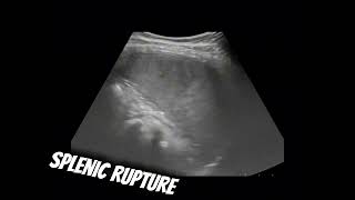 Splenic rupture [upl. by Valenza]