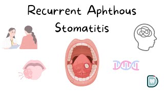 Understanding Recurrent Aphthous Stomatitis RAS or Oral Aphthous Ulcers [upl. by Irv]