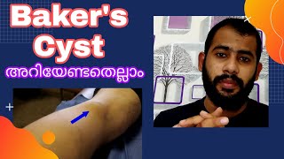 Bakers Cyst MalayalamSymptoms causesTreatment [upl. by Htims]