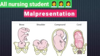 Define presentation and malpresentation [upl. by Darach]