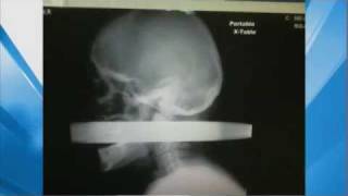 XRay Man Impaled by Pipe in Head Survives [upl. by Luhar]