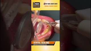 Dental Scaling  Step by Step  Painless Dental Treatment  NDC [upl. by Sillyrama]