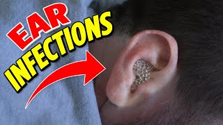 Ear infections the 2 main types [upl. by Server]