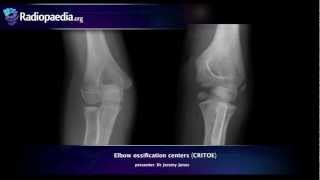 Elbow ossification centers CRITOE  radiology video tutorial [upl. by Neeuq32]