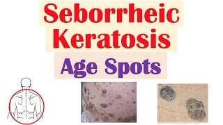 Seborrheic Keratosis “Age Spots”  Risk Factors Causes Skin Lesions Diagnosis Treatment [upl. by Missie]