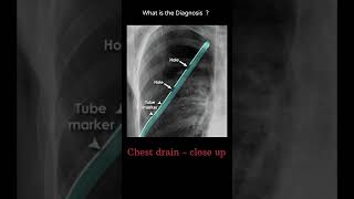 Chest drain  close up 198 chest Xray tubes Quiz radiologychannel007 [upl. by Leeke704]