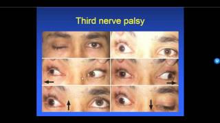 Diplopia 26  Types of Strabismus [upl. by Anawak]