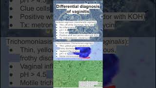 Differential diagnosis of vaginitis [upl. by Marcel]