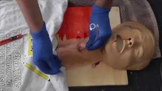 Cricothyroidotomy [upl. by Atilrep242]