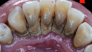 Teeth are cleaned by removing tartar  tartar removing teeth  tartar [upl. by Otilia]