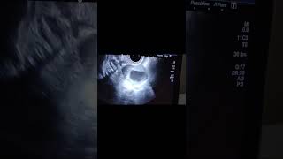 Extra Uterine Pregnancy With Ovarian Cyst [upl. by Htebiram225]