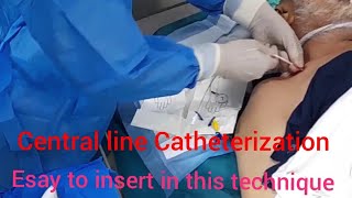 Central line Catheterization without ultrasound guideEasy and simple insert of this technique [upl. by Mendie]