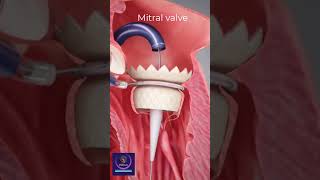 Heart Stent Mitral Valve of A Heart Replacement shorts cardiology [upl. by Nahgen]