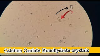 Dumbells crystals in urine microscopyCalcium oxalate monohydrate crystals seen in urine microscopy [upl. by Julia]