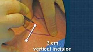 Cricothyrotomy [upl. by Ahseyt]