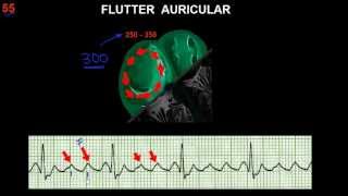 CURSO DE ELECTROCARDIOGRAFIA 55  FLUTTER Y FIBRILACIÓN AURICULARES [upl. by Odinevneib]