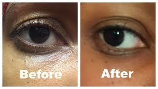 How I corrected my saggy hooded eyelid without surgery [upl. by Iaras]