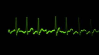 EKG Fibrilacion Auricular [upl. by Aennaej]