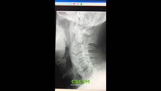 Diffuse Idiopathic Skeletal Hyperostosis DISH Explained by a Chiropractor [upl. by Gurias]