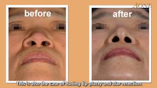 Rhinoplasty  Alar Resection [upl. by Atinniuq]