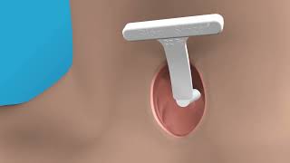 Blom Singer Dilator Sizer animation [upl. by Loralie]