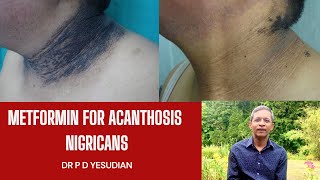 Oral metformin for acanthosis nigricans [upl. by Assert]