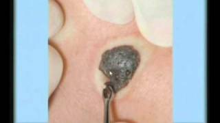 Seborrheic Keratosis Treatment [upl. by Eniar628]