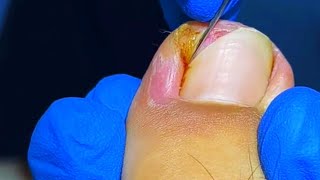 Huge Ingrown Toenail Removal by Top Podiatrist [upl. by Chak675]