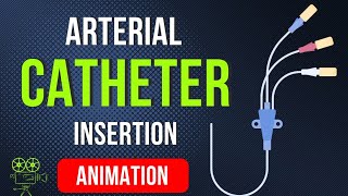 ARTERIAL CATHETER INSERTION  PLACEMENT  ANIMATION [upl. by Aldos19]