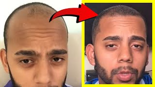 Crazy Minoxidil 5 Hair Growth in 25 Months Fails after 25 YEARS Heres WHY [upl. by Litch]