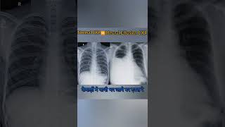 Diffrence between Normal Chest X ray ampPleural effusion medicalimaging xray radiology [upl. by Tenahs]