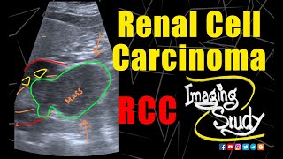 Renal Cell Carcinoma  RCC  Ultrasound  CT  Case 197 [upl. by Emmaline]