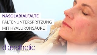 Nasolabialfalte  Faltenunterspritzung mit Hyaluronsäure  daesthetic [upl. by Aerdnad463]