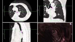 Virtual Bronchoscopy using OsiriX [upl. by Aivataj]