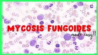 Mycosis Fungoides  WBC disorders  Sezary Syndrome [upl. by Langham588]