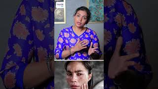 Most common and uncommon skin changes while Pregnancy  DrPriya Kalyani [upl. by Fisa]