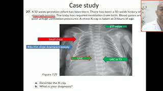 Case 107 lung hypoplasia oligohydramnios sequence potter syndrome [upl. by Melloney]