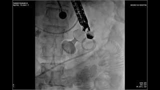 EUS GASTROJEJUNOSTOMY  FREEHAND TECHNIQUE [upl. by Inek]