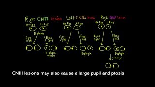 Schneid Guide to Diplopia caused by lesions to CNIII CNVI and the MLF [upl. by Chamkis110]