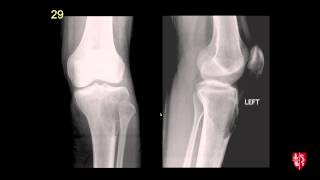 Radiology Boards Prep  MSK Cases [upl. by Hepsoj]