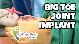 Big Toe Joint Implant for Pain and Arthritis [upl. by Tomaso]