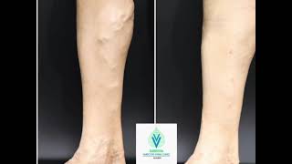 Laser Treatment and Sclerotherapy of Varicose Veins [upl. by Enymsaj]