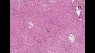 Histopathology LiverViral hepatitis [upl. by Melisse]