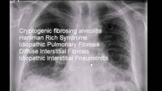 Chest xray idiopathic pulmonary fibrosis cryptogenic fibrosing alveolitis [upl. by Aicenra193]