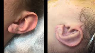 Dr Sherrell Aston Otoplasty Ear Pinning Surgery Before and After [upl. by Raynell420]