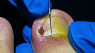 Watch PROFESSIONAL Pedicurist Remove Huge Ingrown Toenail [upl. by Atla]