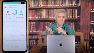 Le derivazioni cardiache spiegate in modo facile e il Kardia Mobile 6L [upl. by Akinom]